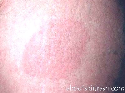 Lyme disease rash-Pictures, Symptoms, Causes, Treatment – About Skin Rash