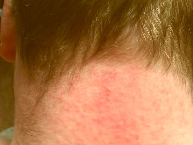 stress-rash-pictures-symptoms-treatment-causes-about-skin-rash